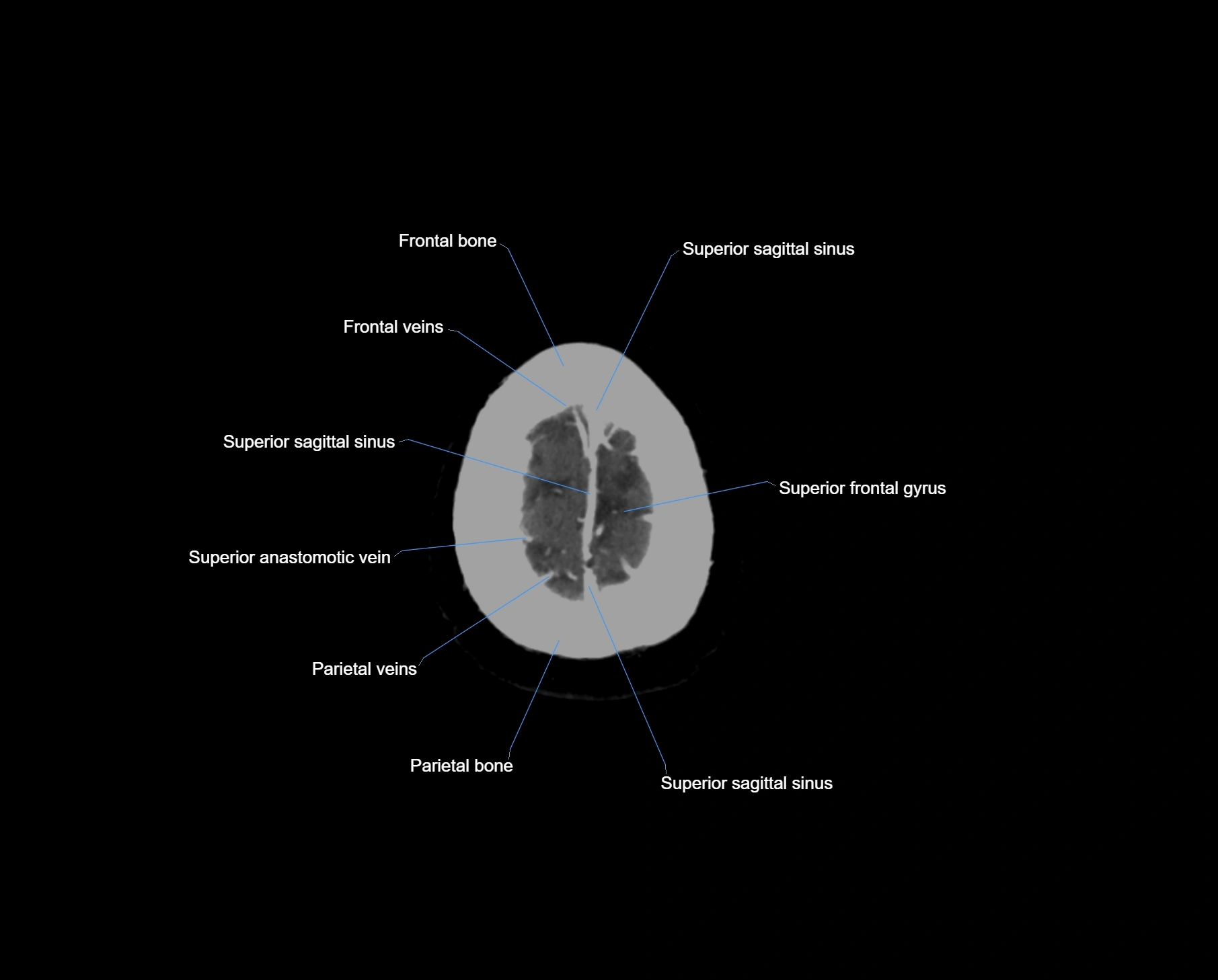 CT scan brain axial labelled cross sectional anatomy image-img-000069.webp